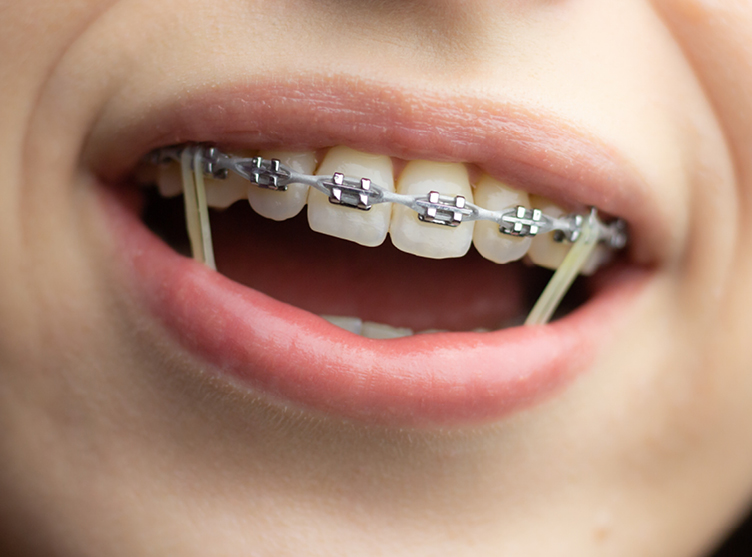 Other Ortho Appliances