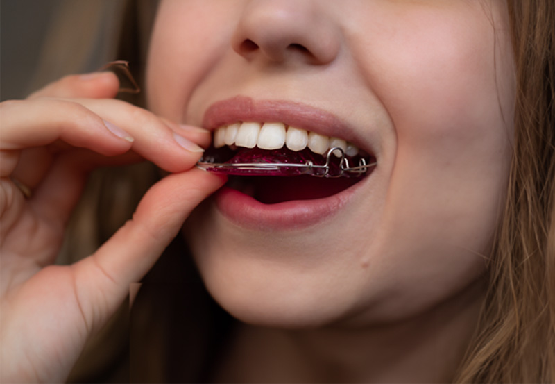 Retainers